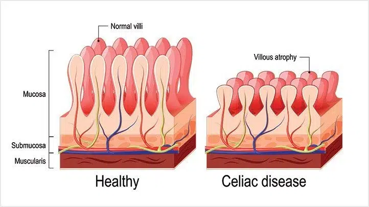 Healthy vs celiac disease intestinal villi comparison diagram.
